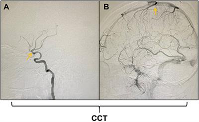 Cerebral Circulation Time Is a Potential Predictor of Disabling Ischemic Cerebrovascular Events in Patients With Non-disabling Middle Cerebral Artery Stenosis